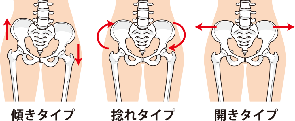 産後の骨盤の歪みによるお悩みTOP10!